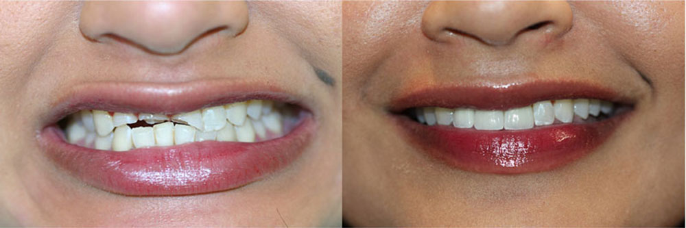 Teeth Implants Before and After