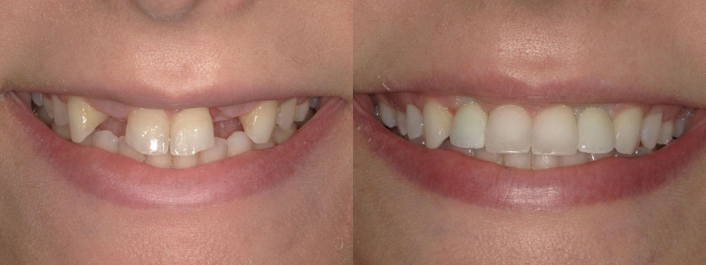 Invisalign Before and After
