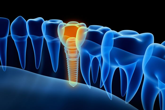 Dental Implants Transform