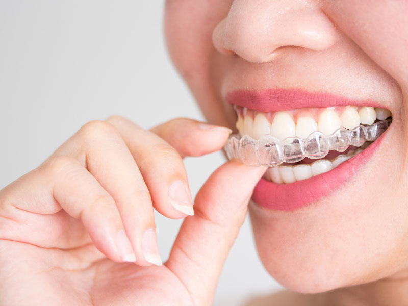 Invisalign Adults