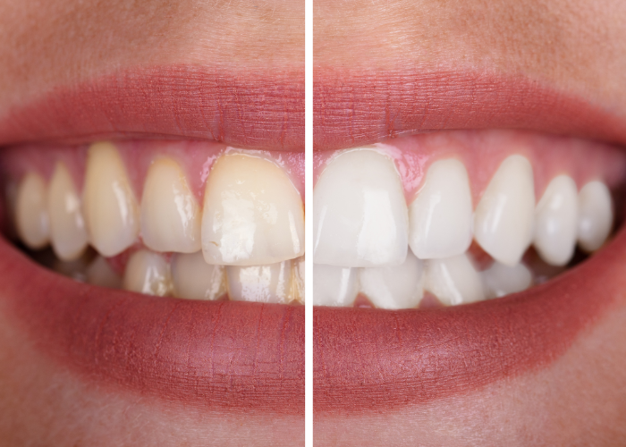 Teeth Whitening Dentist Orlando